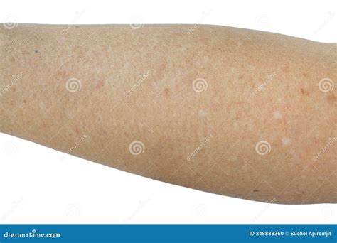 Light Brown Spots On The Arm at Sharon Conner blog