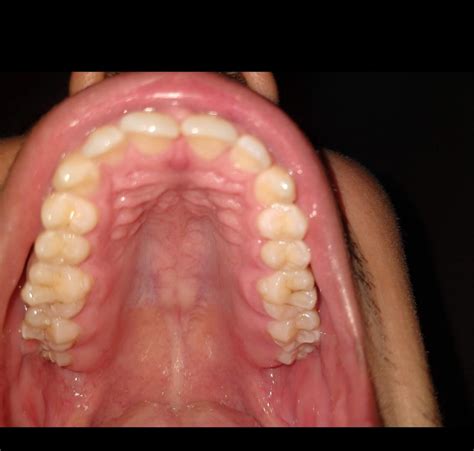 Is this high arched palate? : r/askdentists