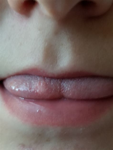 Bumps On Tip Of Tongue