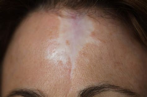 Cosmetic Camouflage Makeup For Stretch Marks | Saubhaya Makeup