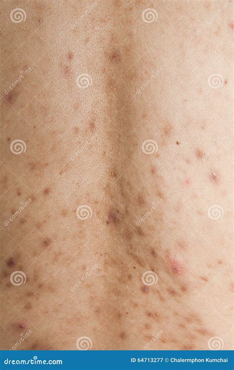 Skin Acne Dermatologist Doctor Before Allergy Stock Image | CartoonDealer.com #235605391
