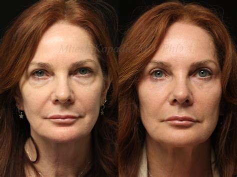 Before and 6 months after upper and lower blepharoplasty surgery with lower lid CO2 laser ...