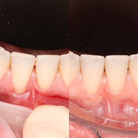 Gingival Graft Before And After Soft Tissue Grafting: What To Know