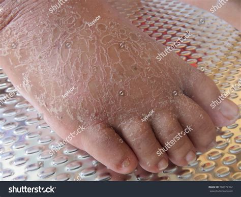 What Causes Peeling Skin On Feet