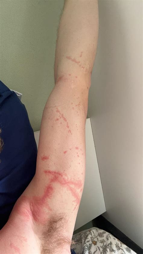 Man O War Sting Marks