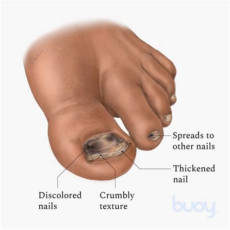 What Causes Black Spots Under Your Toenails at Brenda Norris blog