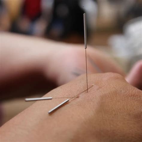 Relieve Pain With Dry Needling | Physical Therapy Associates
