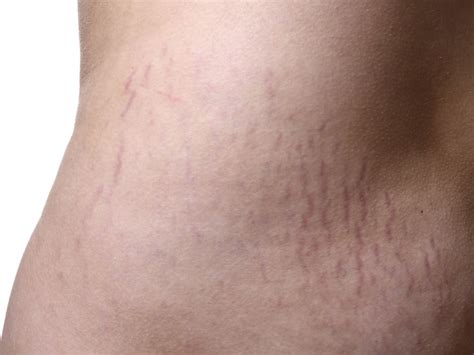 Stretch Mark - 67 Degrees Cosmetic Clinic