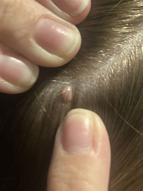 Mole on scalp? This appeared in December. No pain, I just noticed it when washing my hair ...