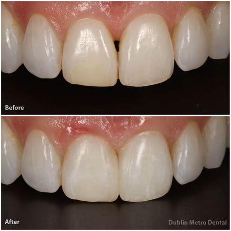 Black Triangle Teeth Gaps | Dublin Metro Dental