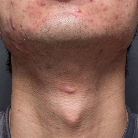 Acne Treatment: Treat Acne Professionally - Rejuvenation Clinics of ...