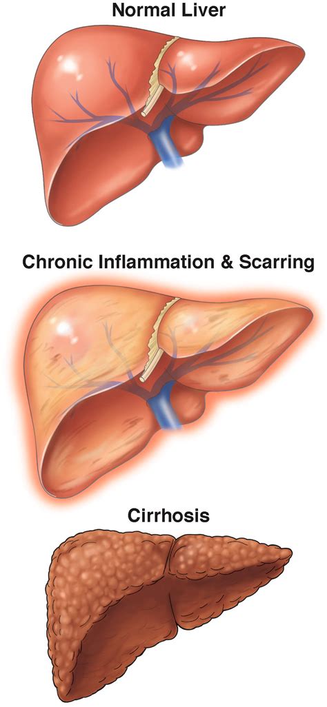 Cirrhosis - AGA GI Patient Center