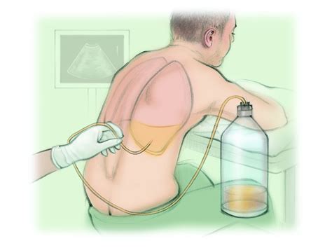 Thoracentesis Fluid