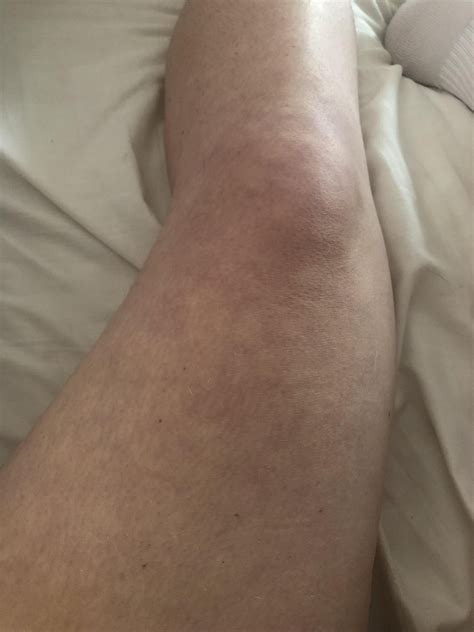 Mottled Skin