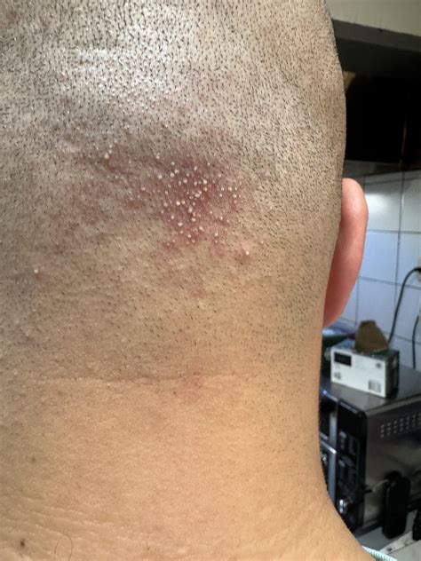 Shave Pimples