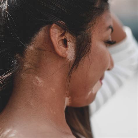 How I Gave Up Hair Dye to Embrace My Vitiligo Hair