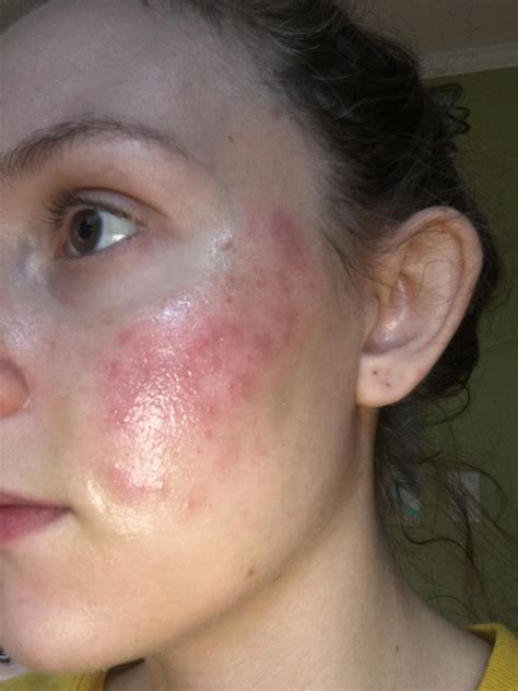 How Do You Treat A Chemical Burn On Your Face at Taylah North blog