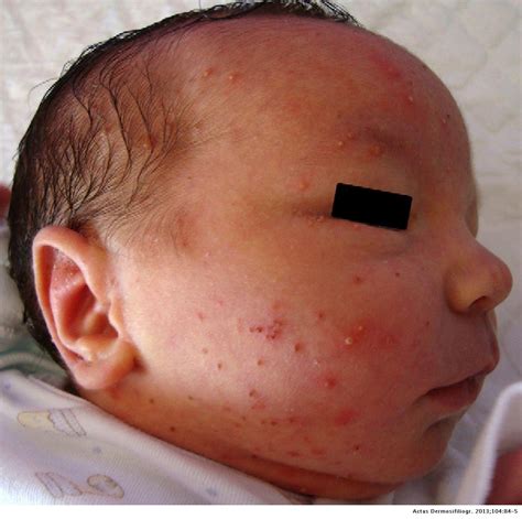 Neonatal Pustular Melanosis