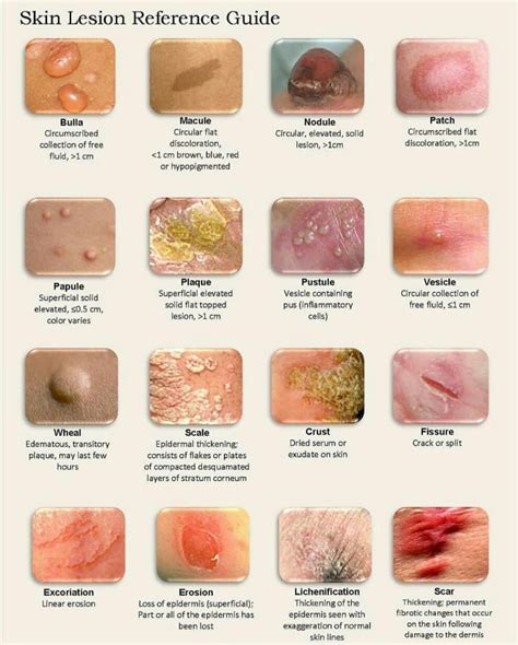 Dermatology Terminology Of Skin Lesions