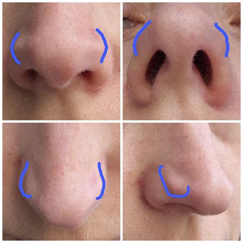 What are these weird cartilage bulges on my nose? : r/Noses