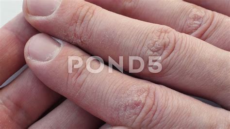 Dry Skin Hands