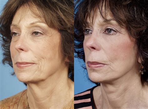 Mid Facelift in Chicago, IL - TLKM Plastic Surgery