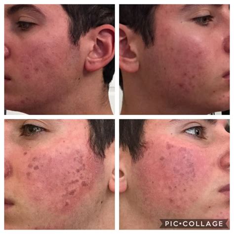 Rosacea Laser Treatment Bruising