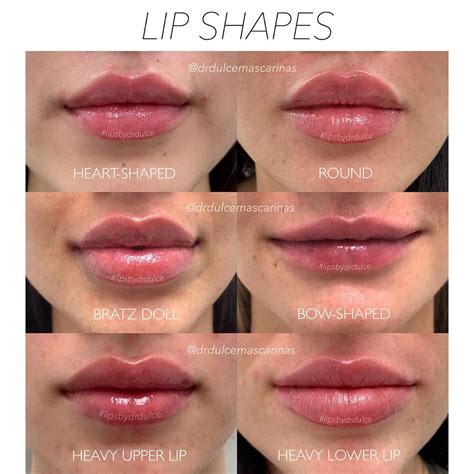 Lip Shape Chart For Fillers at David Haas blog
