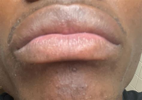 Is this herpes or fordyce : r/Coldsore