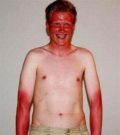 Viral Strange - 39 Of The Worst Sunburns