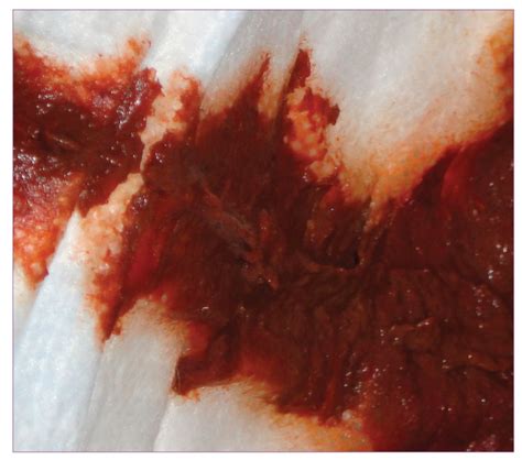 Correspondence: Cefdinir and Red Stool - PMC