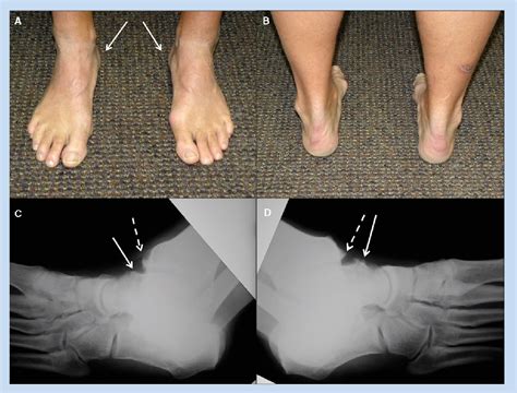 Foot Exercises For Bone Spurs at Lisa Bassett blog