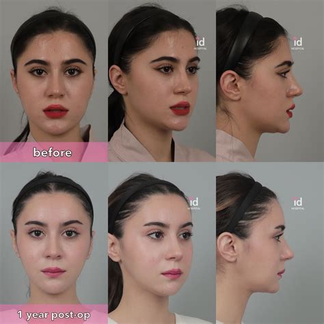 Facial contouring surgery before and after | Facial contouring, V line surgery, Nose surgery