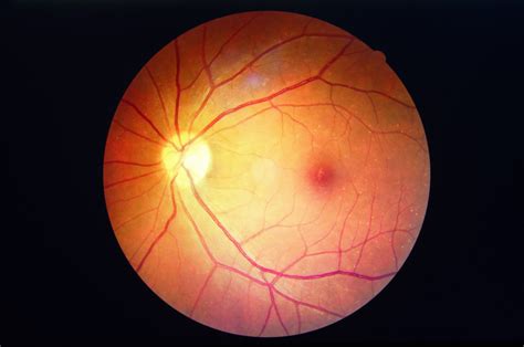 Macular Hole Vision