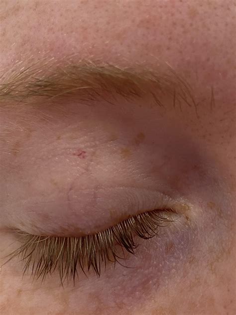 woke up with a red spot on my eyelid? What is it? : r/Dermatology