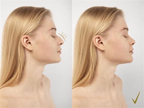Choosing the Perfect Nose: High vs. Low Bridges in Rhinoplasty