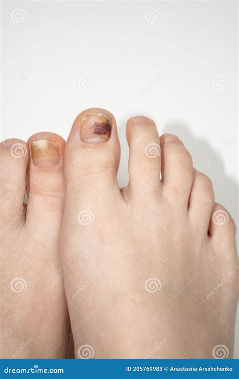 Bruising Under the Fingernail of the Big Toe and Yellow Fungal Nail Stock Image - Image of ...
