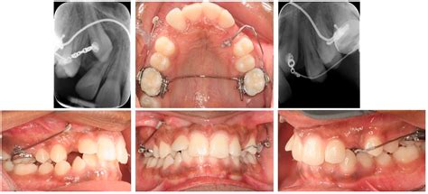 Cantilevers: Multi-Tool in Orthodontic Treatment