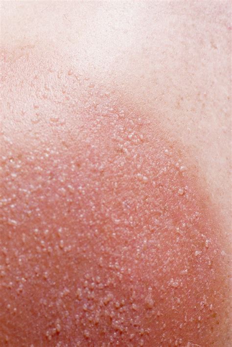 7 types of eczema symptoms causes and pictures – Artofit
