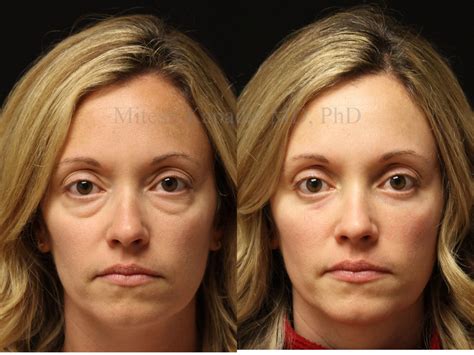 Before and four months after lower blepharoplasty and upper nasal fat pad removal surgery ...