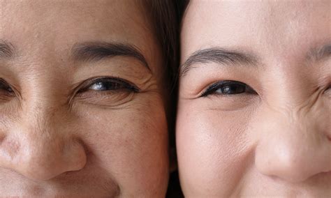 Wrinkles Around Eyes Crows Feet at Eileen Crofts blog