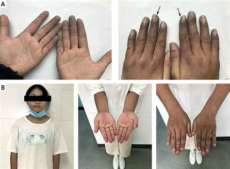Raynaud’s phenomenon in childhood-onset systemic lupus erythematous