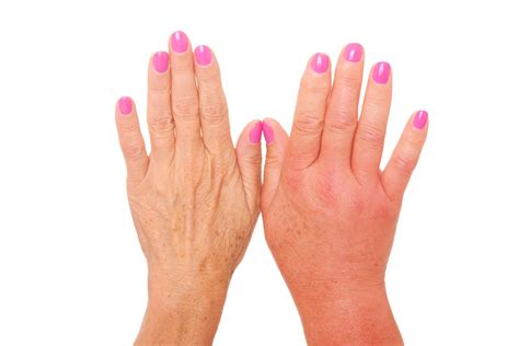 Hand Pain With Psoriatic Arthritis at Petra Ward blog