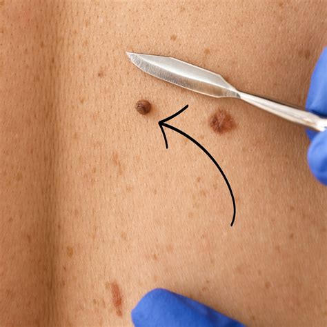 What Is The Difference Between A Skin Tag And Mole at Ruby Ethel blog