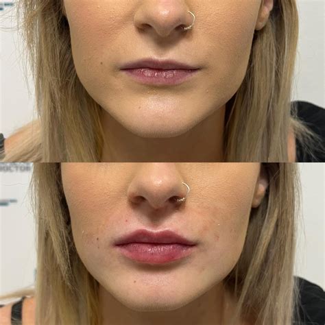 Natural Lips, Facial Fillers, Botox Fillers, Botox Before And After, Lip Fillers Before After ...