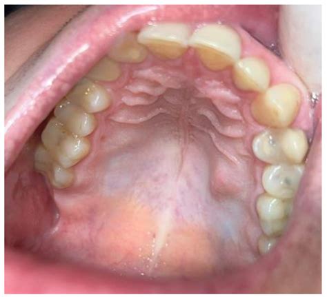 Traumatic Neuroma of the Hard Palate Mimicking a Small Salivary Gland ...