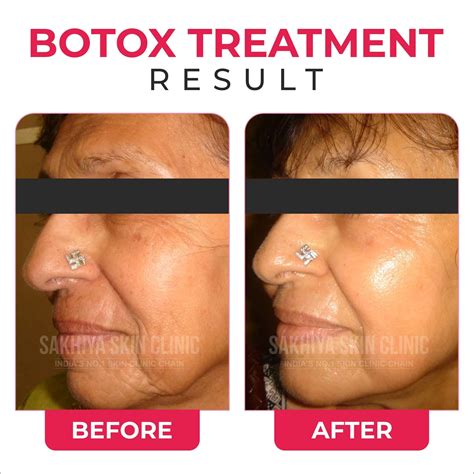 Botox Treatment - Procedure, Benefits & Side Effects