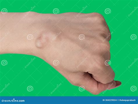 Wrist Ganglion Cyst Disease , Ganglion Cyst , a Fluid-filled Lump Under the Skin , Pain Hand ...
