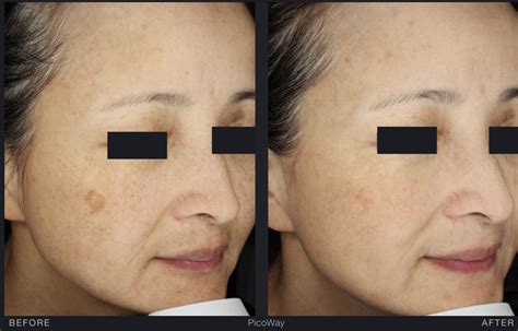 Melasma and Hyperpigmentation Laser Treatment Melbourne