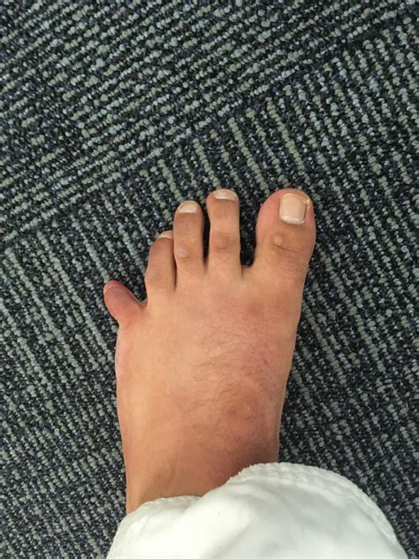 Should I Use Crutches For A Broken Pinky Toe at Mark Cortese blog